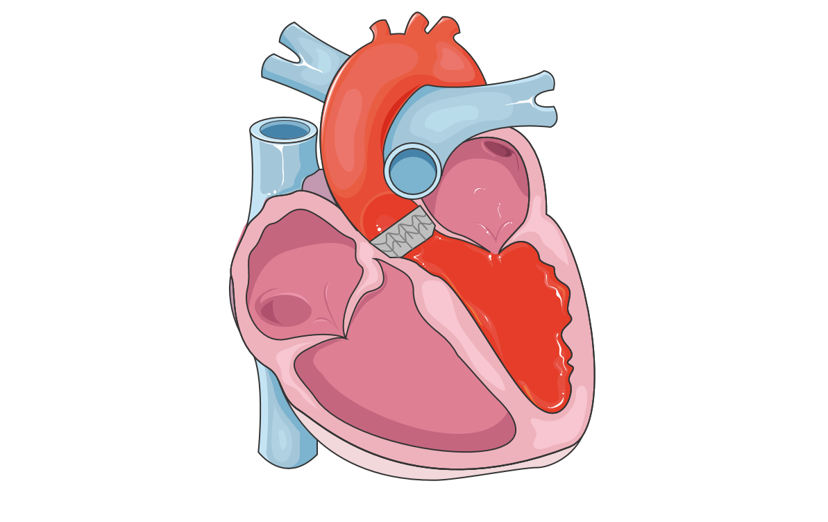 Valve aortique par voie transcutanée